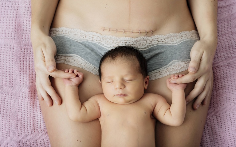Neugeborenes Mädchen, liegend zwischen den Oberschenkeln der Mutter, die eine deutlich sichtbare, frische und geklammerte Narbe nach Kaiserschnitt hat
